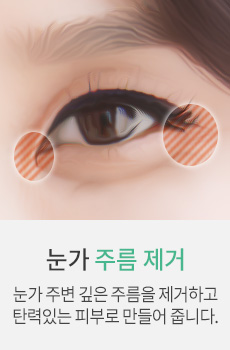 눈가 주름 제거