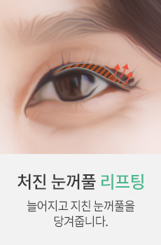 처진 눈꺼풀 리프팅
