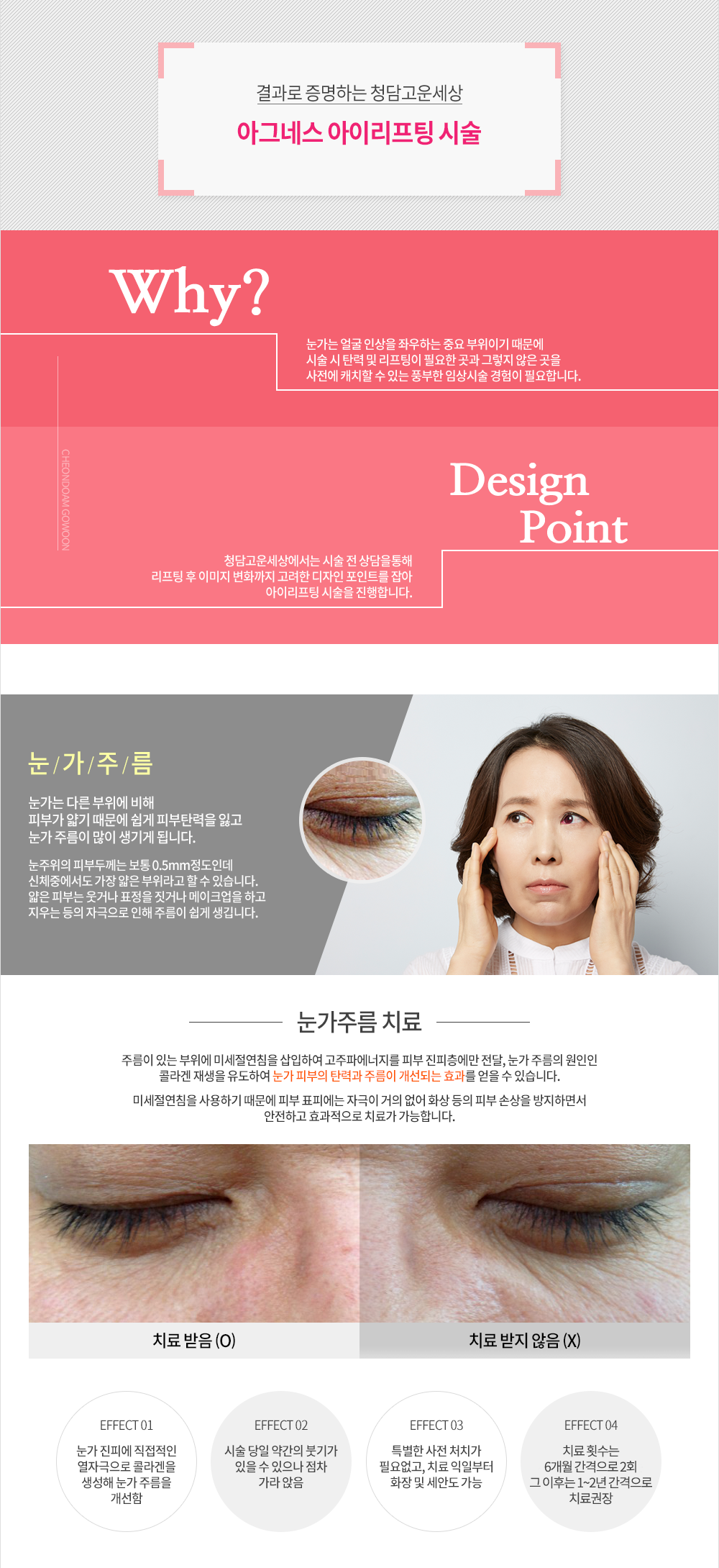 아그네스 아이리프팅 시술