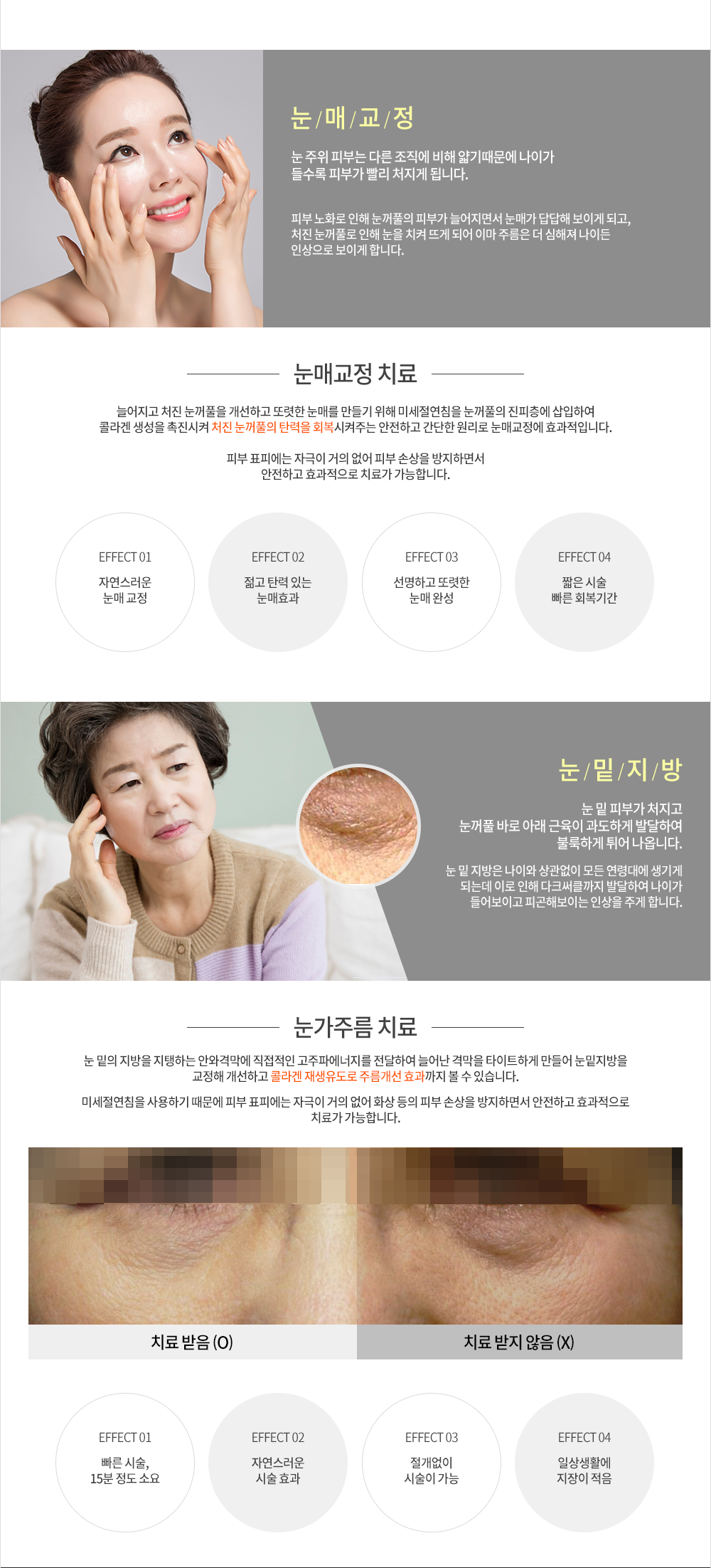 눈매교정